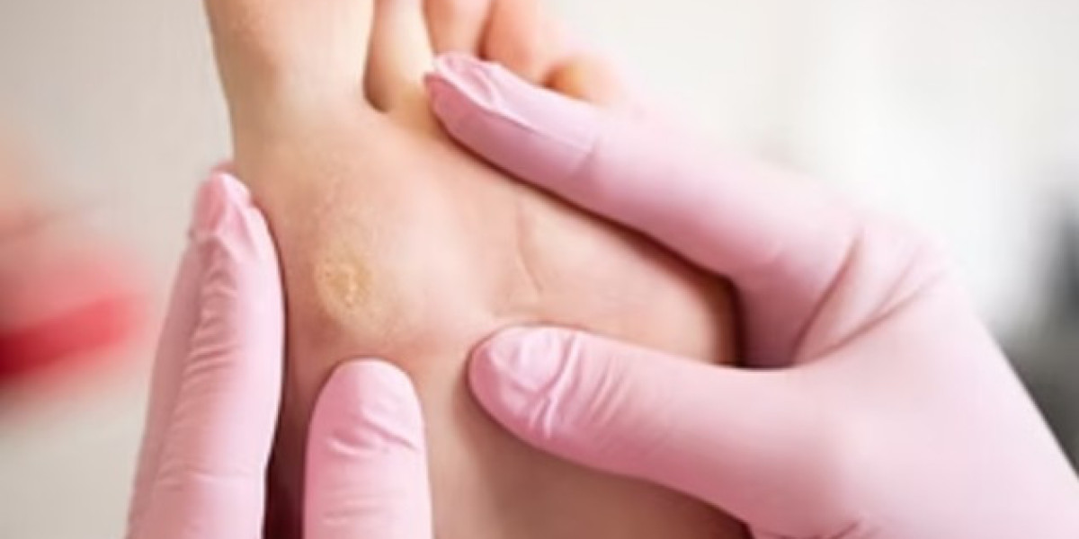 Why callus removal in Singapore is safer with a trained podiatrist