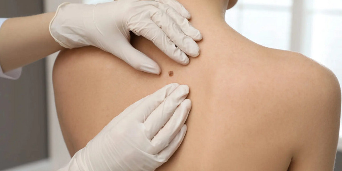 Mole Removal In Dubai: Top Clinics Using Technology