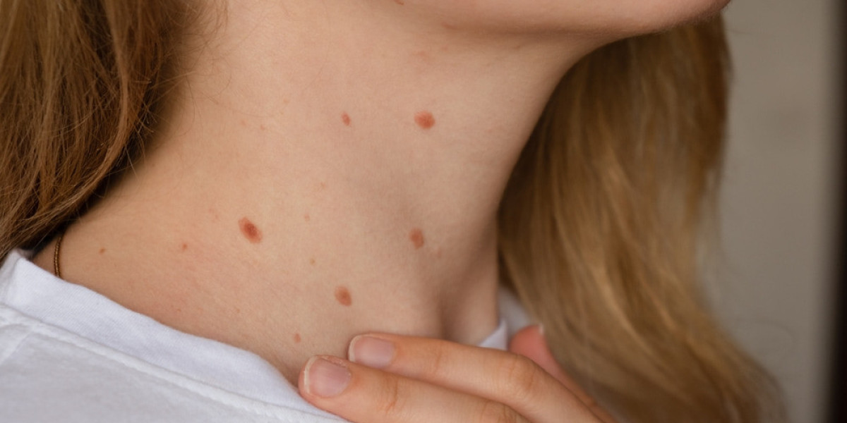 Are Skin Tags Contagious? What You Need to Know