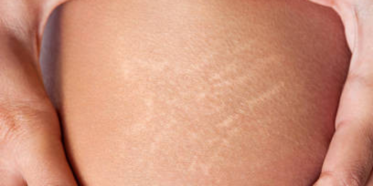 Stretch Mark Removal Explained for Natural Looking Skin