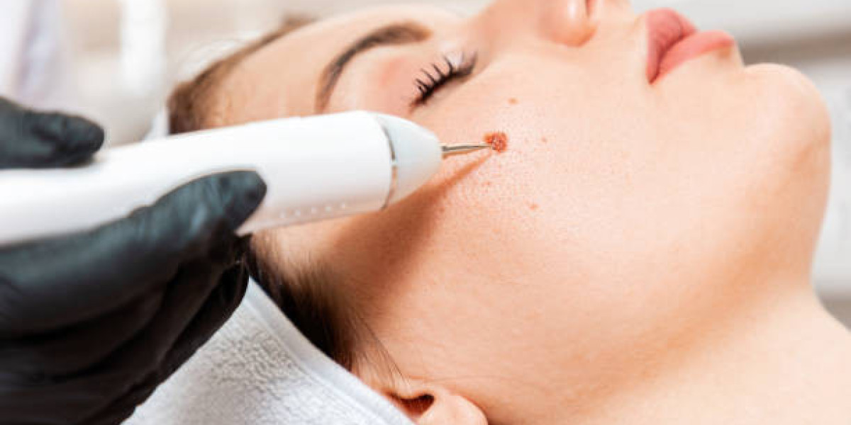 Expert Mole Removal in Dubai for All Skin Tones