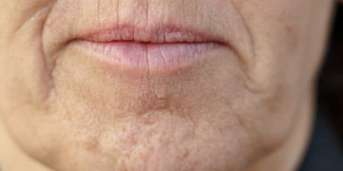 Can Hormonal Changes Cause Wrinkles?