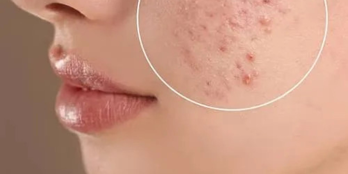 How to Prepare Your Skin Before Acne Scar Treatment?
