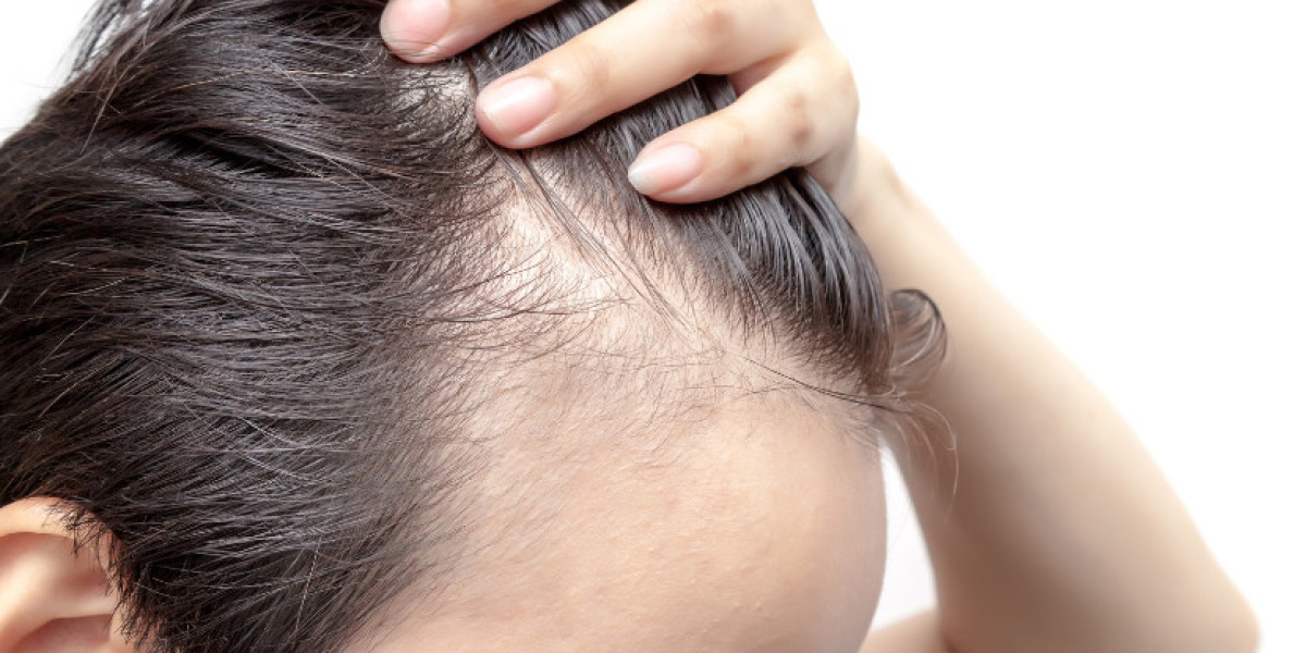 Alopecia Market Size, Trends & Forecast 2035