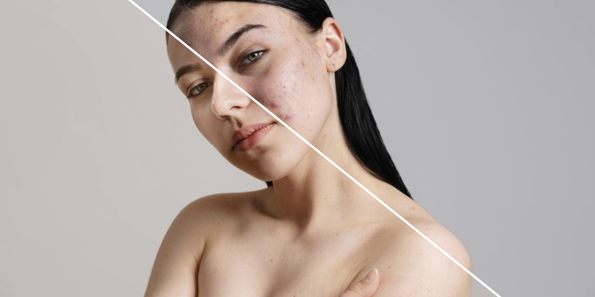 Why Treating Acne Early Can Help Prevent Scarring