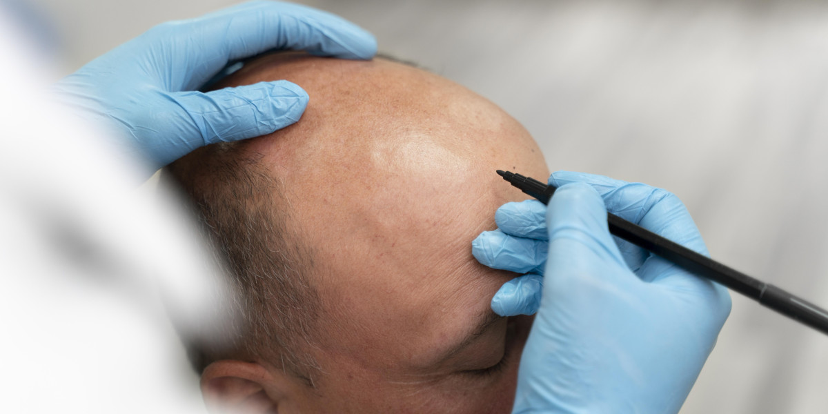 Does Surgeon Experience Change My Hair Transplant Cost?